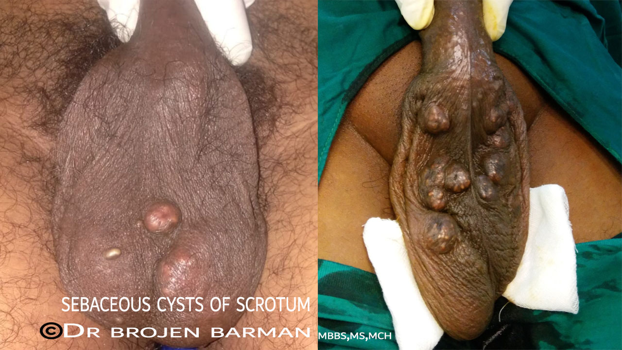 sebaceous cyst - Dr Brojen Barman