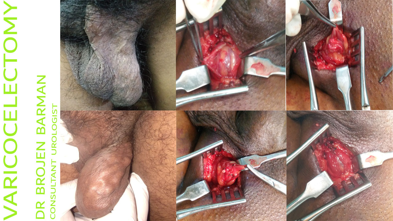 Varicocelectomy - Dr Brojen Barman