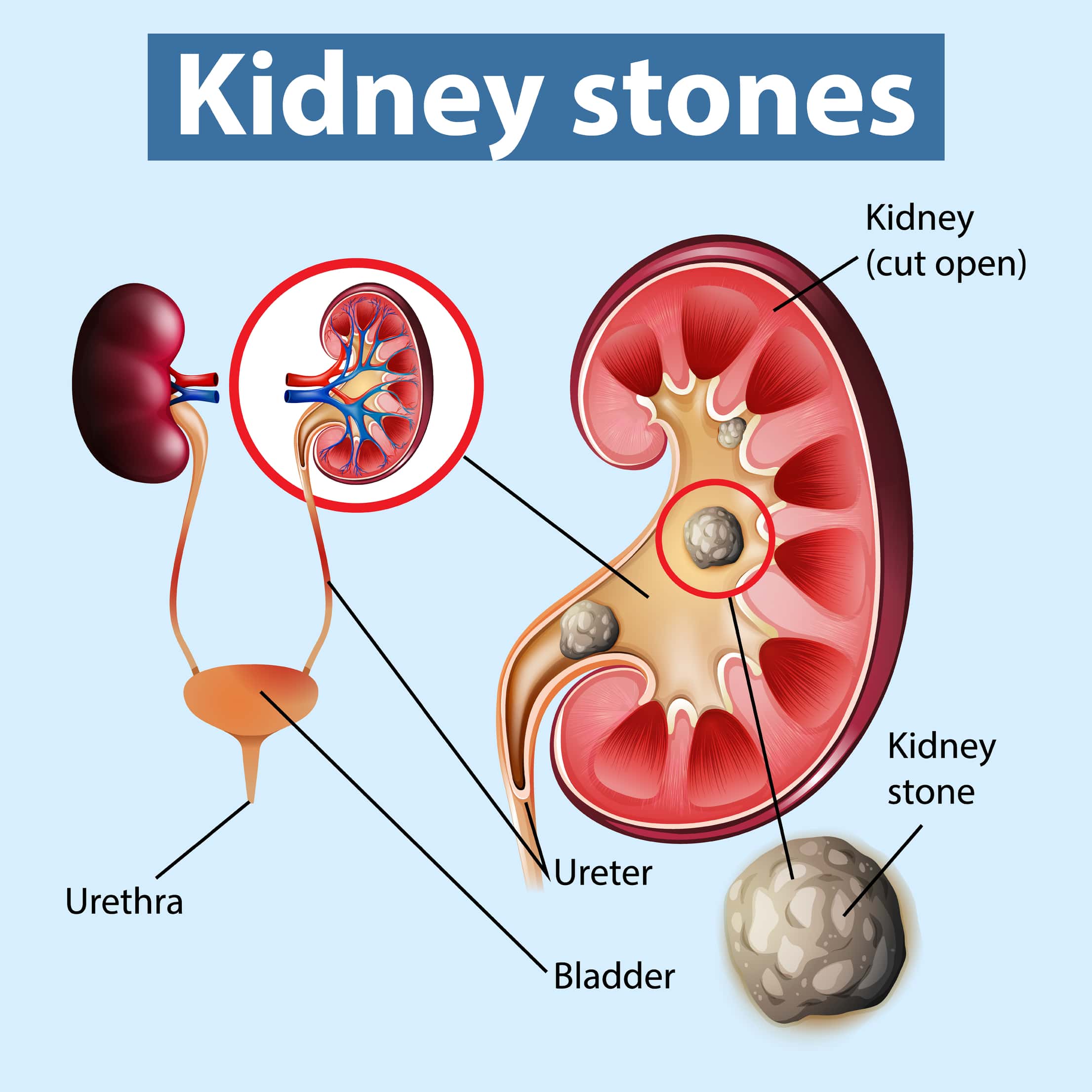 Kidney Stone Diagram
